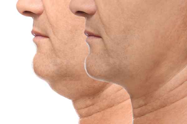HIFU - Breakthrough in Anti - ageing 2 hifu results Eccles