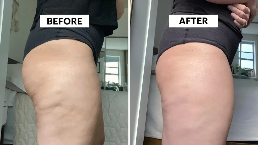 Sculpting Your Bum: Can Toning Exercises Really Reduce Cellulite? 1 Do Toning Exercise Eccles Really Tackle Cellulite?
