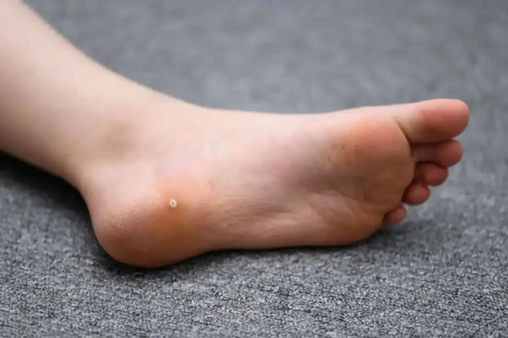 Cryotherapy For Warts And Also Verrucas 2 Image of verruca on the bottom of the foot that able to be treated with Cryotherapy Eccles
