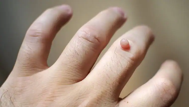 Image of blemish that Cryotherapy Eccles can remove with Lipo 360.