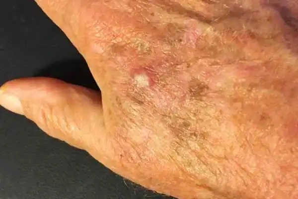 Cryopen For Actinic Keratoses 1 Image of Actinic keratoses Eccles on a person hand