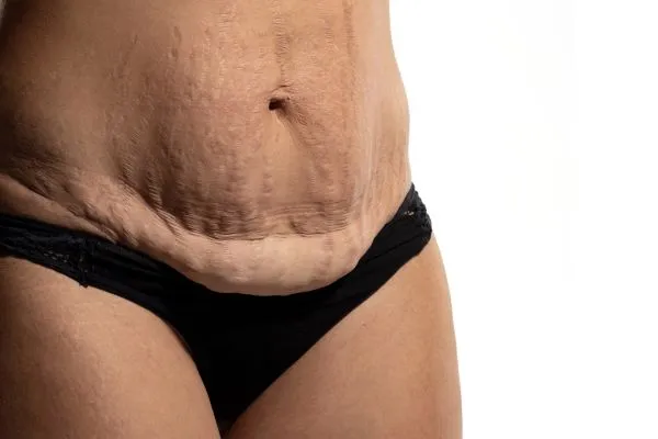 The science behind skin tightening Eccles picture of a woman's sagging skin on the stomach